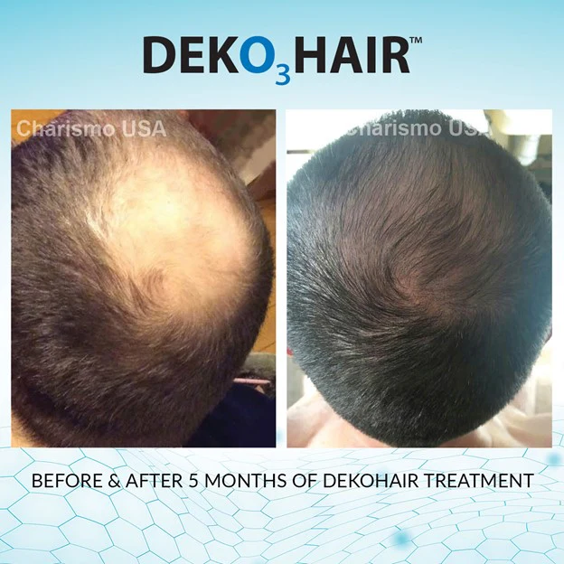 DEKOHAIR 60mL - Image 5